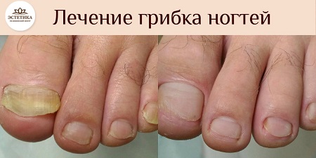 лечение грибка на ногте, результат процедуры