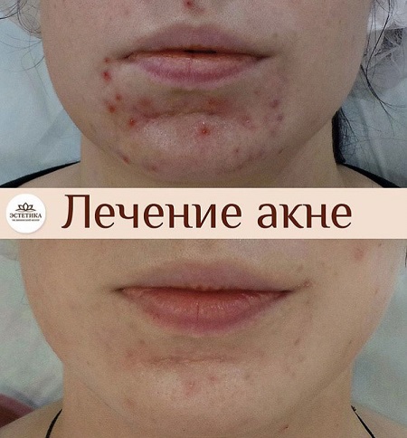 КОМПЛЕКСНОЕ ЛЕЧЕНИЕ УГРЕВОЙ БОЛЕЗНИ