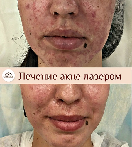 Лечение акне лазером до и после результат процедуры лечения акне