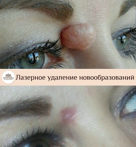 Удаление новообразования до, после результат удаления лазером новообразования