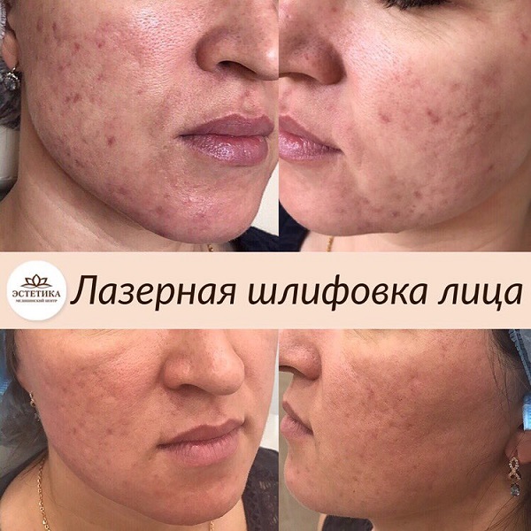 Лазерное омоложение результат