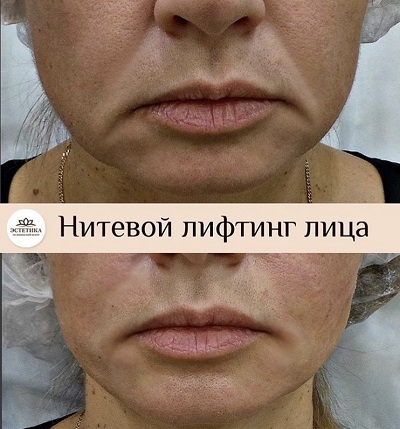 До и после нитевого лифтинга лица результат процедуры лифтинга Aptos