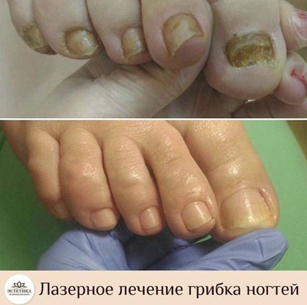 лечение грибка ногтей лазером