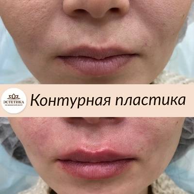 Контурная пластика лица