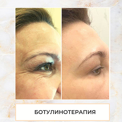 Ботулинотерапия