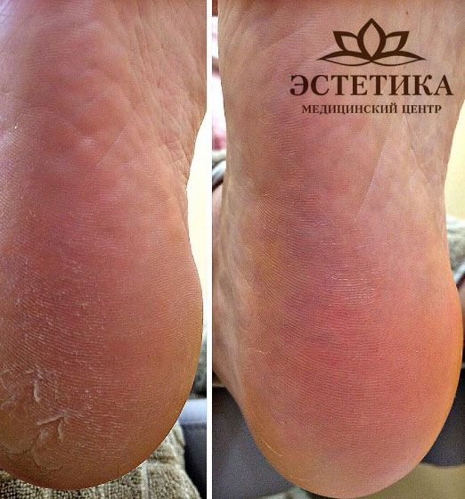 Медицинский педикюр